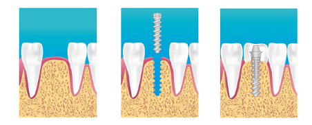 Implant dentaire Neuilly-Sur-Seine
